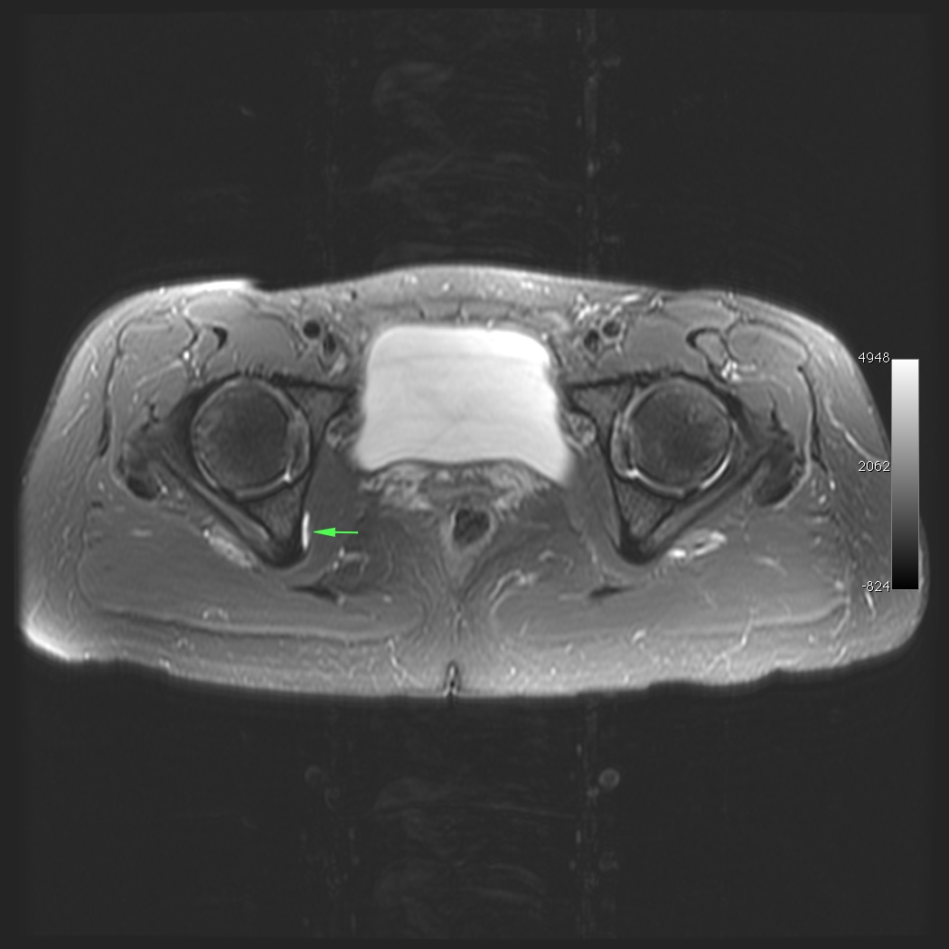Figure 3 for case obturator internus bursitis ( RID2633 )
